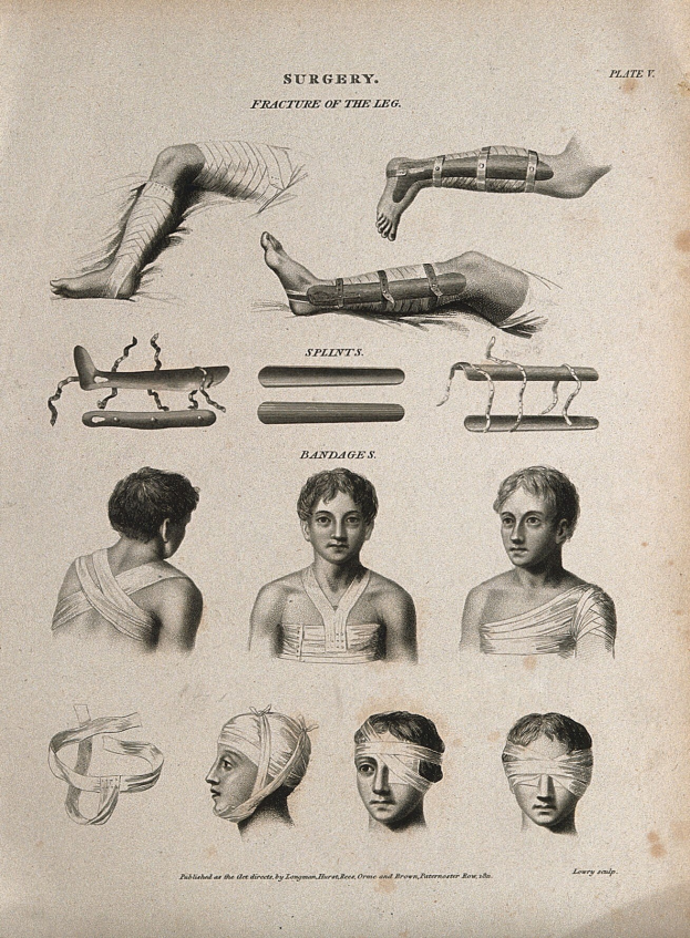Ein altes Illustration eines chirurgischen Verfahrens, das die Beine eines Mannes und den Kopf einer Frau zeigt, beide mit verbundenen Köpfen, begleitet von erklärendem Text.